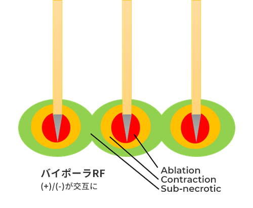 従来のマイクロニードルRF - 作用順序