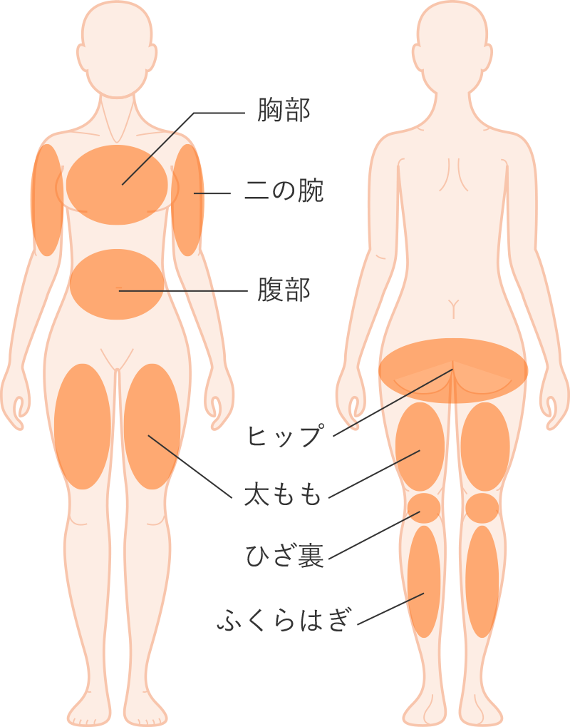 肉割れ（ストレッチマーク）・妊娠線が出来やすい部位