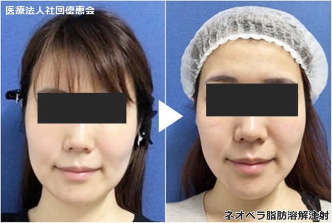 ネオベラ Neobella 脂肪溶解注射 美容皮膚科 銀座よしえクリニック 公式 東京