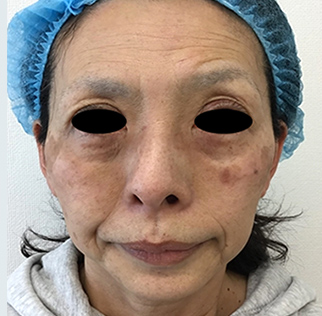 目元のたるみ 目の下のクマ治療 美容皮膚科 銀座よしえクリニック 公式 東京