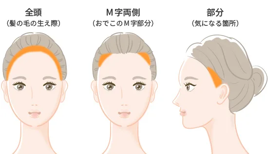 アートメイク ヘアライン 生え際 美容皮膚科 銀座よしえクリニック 公式 東京