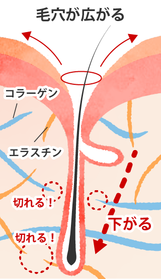 たるみ毛穴の状態